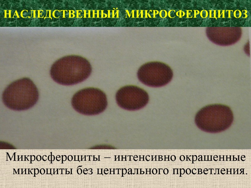 НАСЛЕДСТВЕННЫЙ  МИКРОСФЕРОЦИТОЗ Микросфероциты – интенсивно окрашенные микроциты без центрального просветления.
